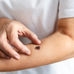 Cilt Kanseri Erken Tanı ve Takibi