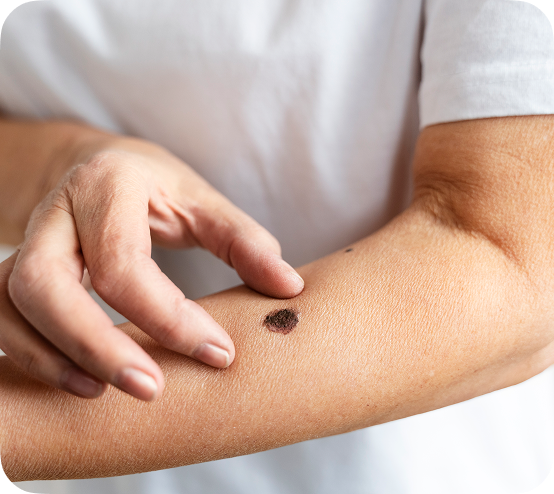 Cilt Kanseri Erken Tanı ve Takibi