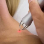 Lazerle Ben (Nevüs) ve Et Beni Alma