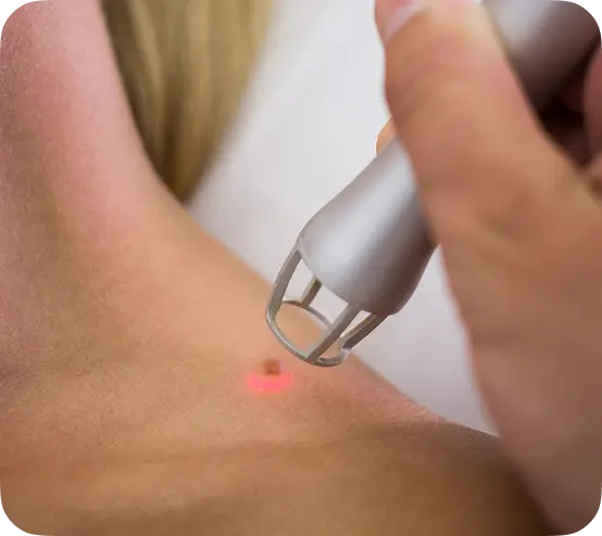 Lazerle Ben (Nevüs) ve Et Beni Alma