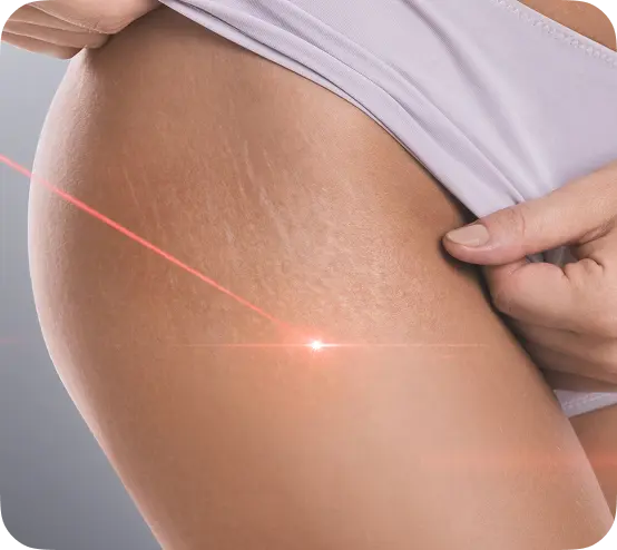 Lazerle Çatlak Tedavisi