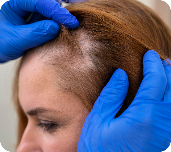 Saç ve Saç Derisi Hastalıkları